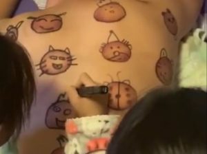 Twin Daughters Add Cute Faces to Father's Cupping Marks